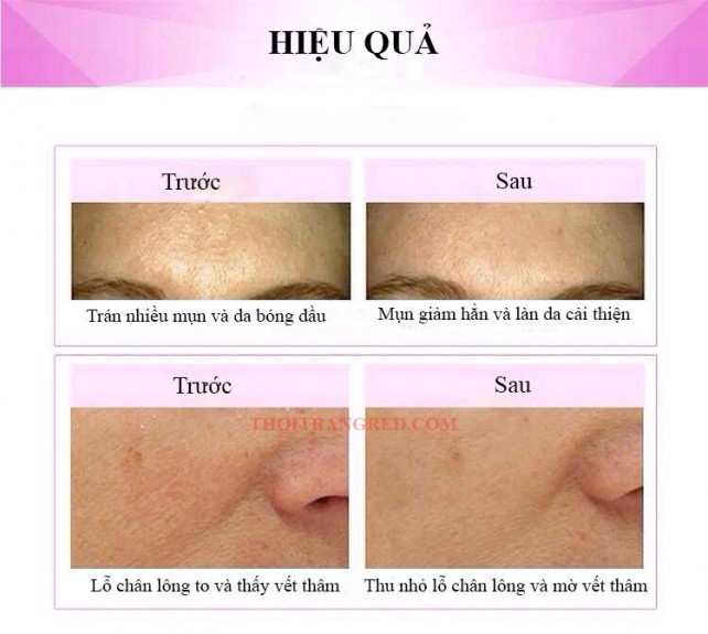 MÁY RỬA MẶT HALIO CẦM TAY VERSION 2 MÁY RỬA MẶT HALIO CẦM TAY VERSION 2